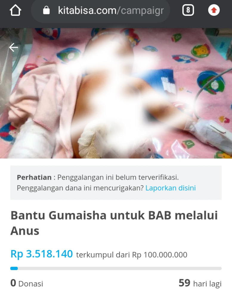 Minta Donasi Biaya Perawatan Rp100 Juta, Ini Klarifikasi Orang Tua Gumaisha