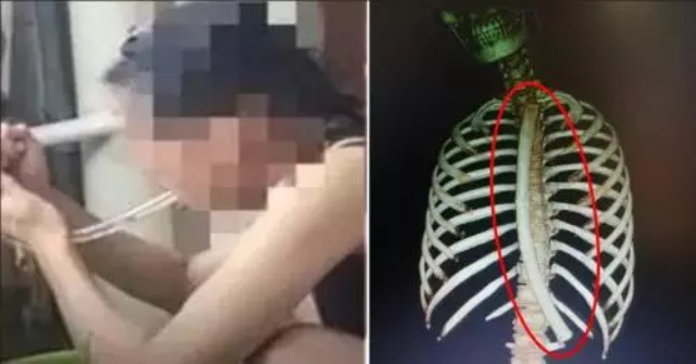 Ingin Langsing, Perempuan Ini Tak Sengaja Telan Selang 30 Cm