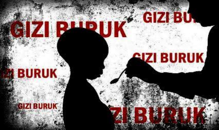 Kisah Balita Gizi Buruk di Pelangiran Tak Kunjung Penuhi Rujukan dari RSUD Puri Husada