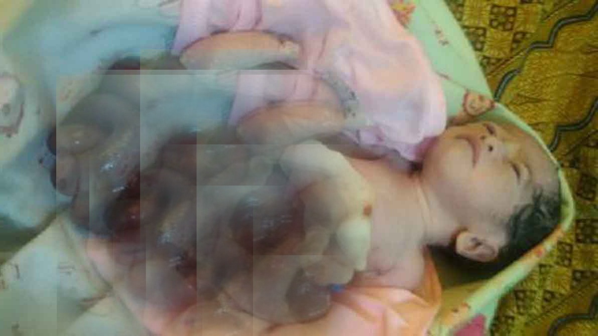 Bayi Ini Butuh Uluran Tangan Untuk Operasi, Terlahir Dengan Kondisi Lambung dan Usus Keluar