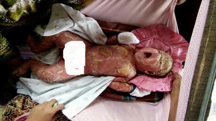 Kulit Melepuh, Bayi Berusia 4 Bulan Ini Butuh Uluran Tangan