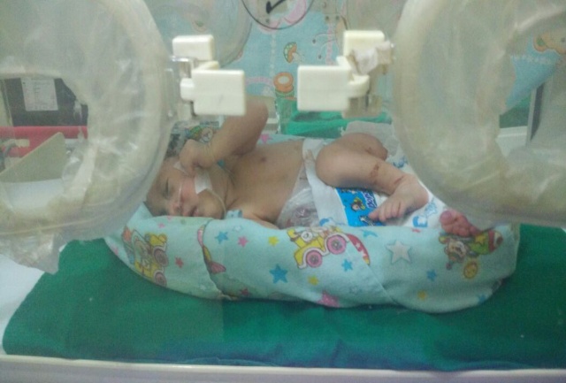 Aneh, Bayi Ini Lahir Dengan Kondisi Usus di Luar
